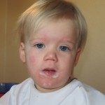 Lille mus med skarlagensfeber