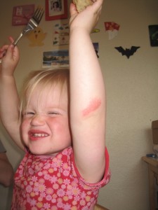 Karens lille sår på albuen